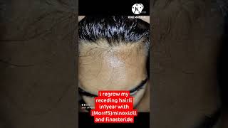 regrow receding hairline after 15 month use of minoxidil Finasteride #shorts