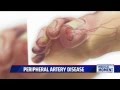 Symptoms and Treatments for Peripheral Artery Disease (PAD)