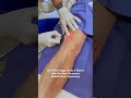 endolift laser get rid of saggy knees u0026 elbows with one easy treatment