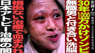 30年1000万かけゾンビ/日本アトピー界の闇/無職男と付き合い洗脳/脱ステロイド・脱保湿