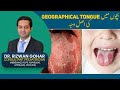 Treatment of Geographic Tongue👅😛 #geographic #tongue #treatment