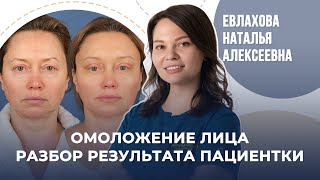 Комплексное омоложение лица / Эндоскопическая подтяжка / Евлахова Наталья Алексеевна