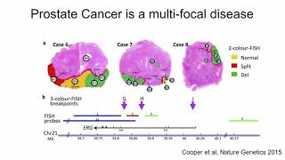 E01.1 Genome sequencing in prostate cancer