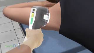 miraDry - Excessive Sweating Treatment