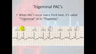 Basic Electrophysiology, part 7 - Atrial Rhythms, part 1, Introduction and PAC's