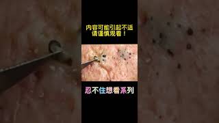 大叔三十年的黑头，粉刺，黑头，#blackhead#强迫症#解压#痘痘粉刺#挤黑头#深层毛孔处理