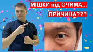 Мішки під оком Як зменшити набряк під оком Причина набряку та мішків під оком