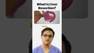 What is Liver Ablation & Resection? #livercancertreatment #resection #ablation #cancer #cancercare