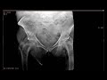 Nanox.ARC - Clinical images of Hip fracture