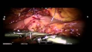 Totally Robotic Biliopancreatic Diversion with Duodenal Switch