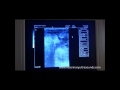 bovine pregnancy diagnosed at 112 days using kaixin kx5000 ultrasound