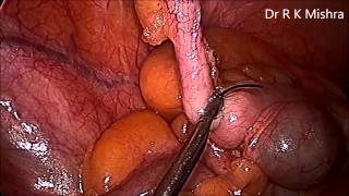 Laparoscopic Appendectomy by Dr. R. K. Mishra