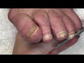 👣 Pedicure Deep Cleaning Excessive Dry Skin from Elderly Toenails and Feet 👣