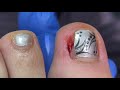 HOW TO REMOVE AN INGROWN TOENAIL IN 3 STEPS (BY A PROFESSIONAL)