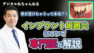 【5分でわかる】インプラント周囲炎についてインプラント 専門医が解説【歯周病】