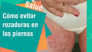 Cómo evitar rozaduras en las piernas | Salud