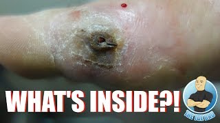 EXTREME FOOT INJURY UNBELIEVABLE REMOVAL!!! WHAT’S STUCK IN THIS FOOT??? FOOT HEALTH MONTH 2018 #15