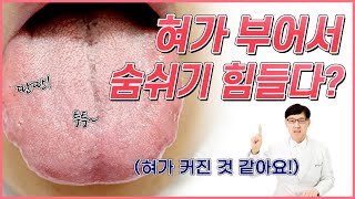 혀붓기 때문에 호흡곤란이 와요! 혀가 붓는 이유 뭐죠?