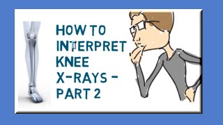 How to interpret knee X-rays - Part 2 - lateral view