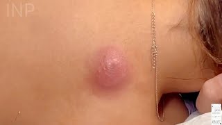 Draining the infected cyst of a pregnant patient | INP