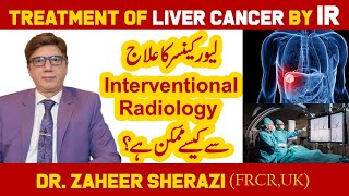 Treatment of Liver Cancer by Interventional Radiology | Liver Cancer ka Ilaj | Dr Zaheer Sherazi