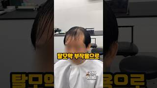 탈모약 부작용으로 약을 못먹음 탈모커버헤어스타일 #kbeauty #korea #hairloss #hair #hairstyle