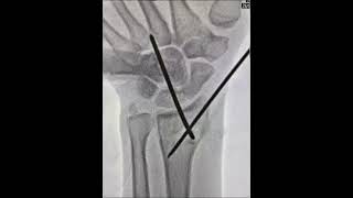 Kapandji reduction Distal radius fracture - Reduction technique