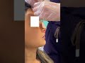 nose job check rhinoplasty before and after cast reveal plastic surgery cosmetic procedure