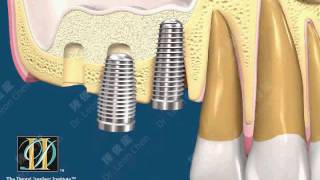 陳俊龍 DII 微創水壓式推鼻竇增高術 (HSC®)
