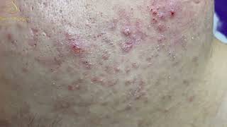 Loan Nguyen Acne Treatment 171e