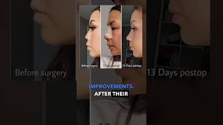 Rhinoplasty recovery after only 2 weeks - with results! ✨