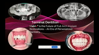 Full Arch Dentistry with matrix® - Surgical and Restorative Prosthetics | Dr. Vishy Broumand