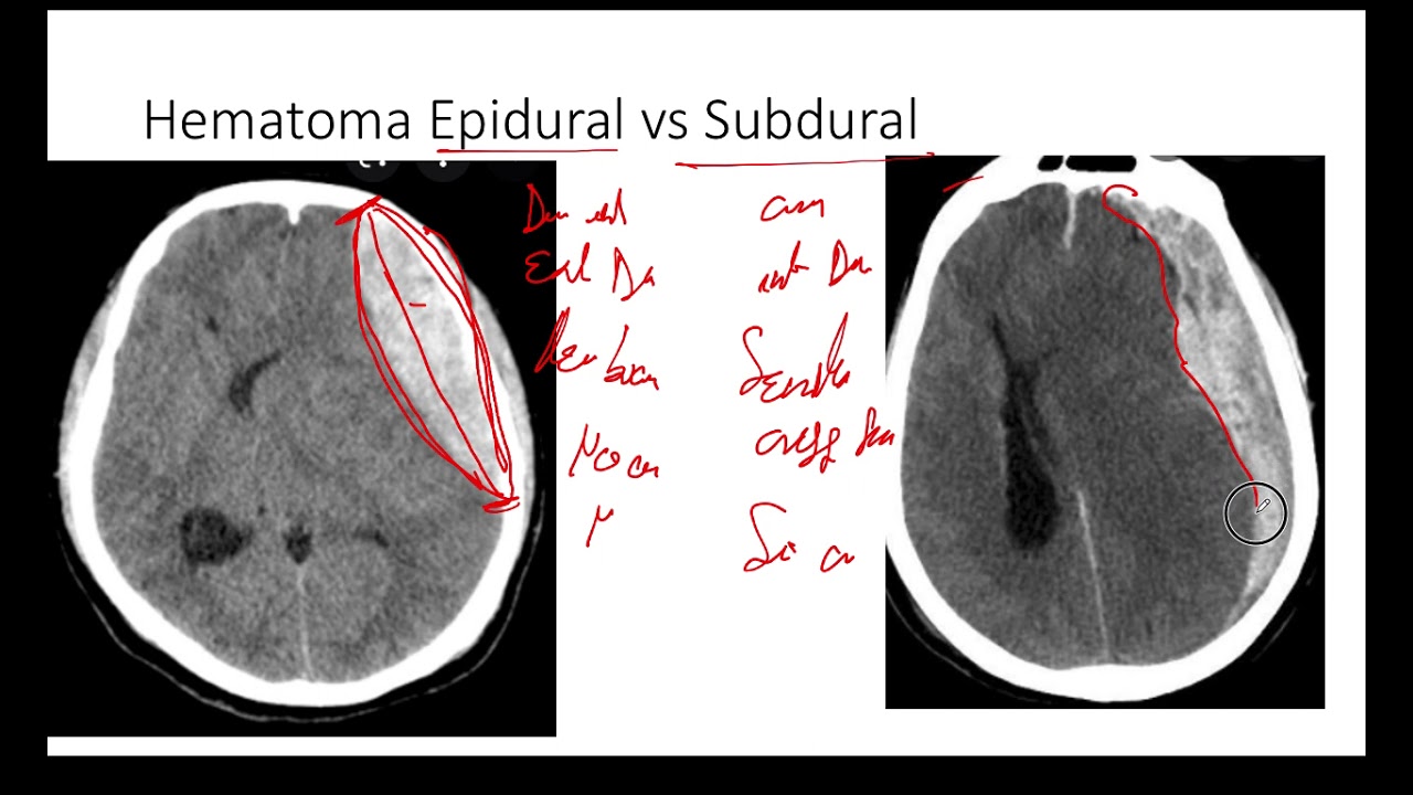 Diferencia En 2 Minutos De Hematoma Epidural Vs Subdural. Tomografía ...