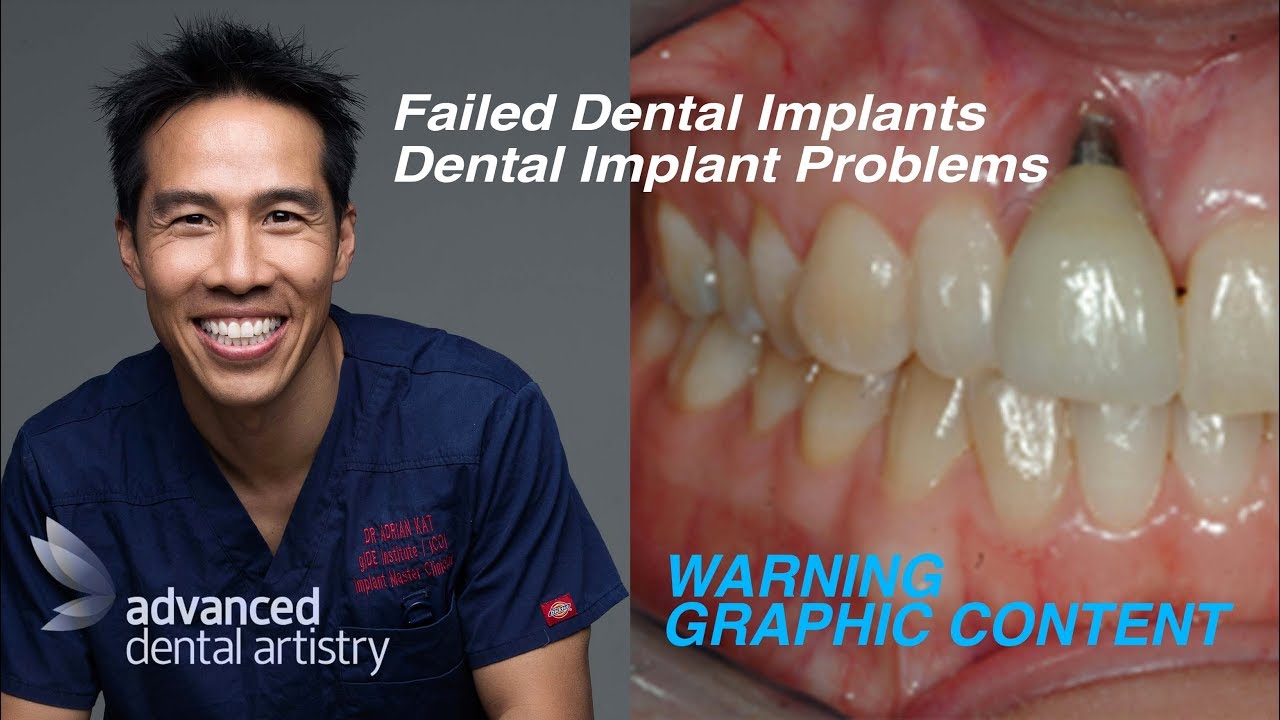 Problems With Dental Implants - Why Do Dental Implants Fail? - YouTube