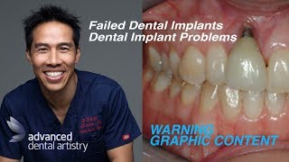 problems with dental implants - why do dental implants fail?