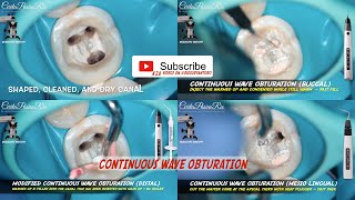 modified continuous wave obturation technique bioceramic sealer fast fill fast pack eighteeth MOLAR