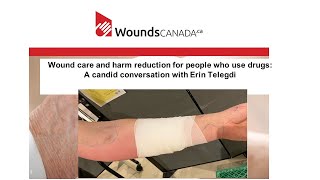 Webinar Presentation: Wound Care and Harm Reduction in People Who Use Drugs