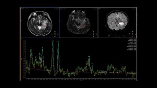 Mesial temporal lobe tumor