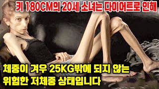 키 180cm의 20세 소녀는 다이어트로 인해 체중이 겨우 25kg밖에 되지 않는 위험한 저체중 상태입니다