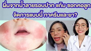 ผื่นจากน้ำลายรอบปาก แก้ม ซอกคอลูก ทาครีม ทายาอะไรให้หาย|แม่โบNurse Kids