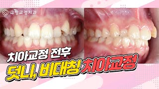 덧니/비대칭 치아교정 전후영상_그랑교정치과