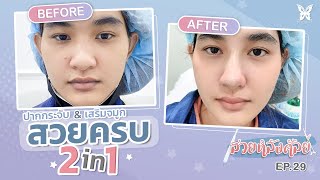 สวยครบ 2in1!! เสริมจมูกและปากกระจับ เลิศมากเวอร์ l สวยหลังศัลย์ EP.29