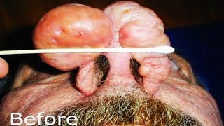 World's Largest Nose Cyst or Rhynophyma!