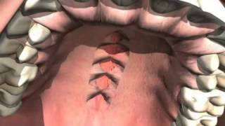 What is a Cleft Palate?