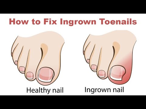 How to Fix Ingrown Toenails Quickly and Easily How to Fix Ingrown Toenails Quickly and Easily