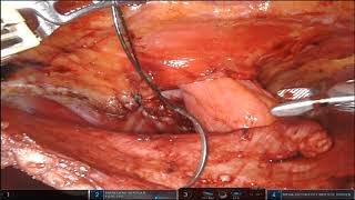 Robotic Modified Sugarbaker Parastomal Hernia Repair