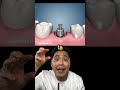 implante o diente natural dientes dentista tips parati viral fyp shorts shortvideo fypシ