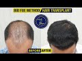 Best Hair Transplant Surgery In Mumbai ||The Hair and Shape Clinic ||Bio Fue Method Hair Transplant