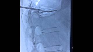 Percutaneous Vertebroplasty