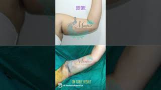 Arms contouring VASER Liposuction Dr Kedarnath Pandya Ahmedabad Vadodara Rajkot Bhavnagar Mehsana